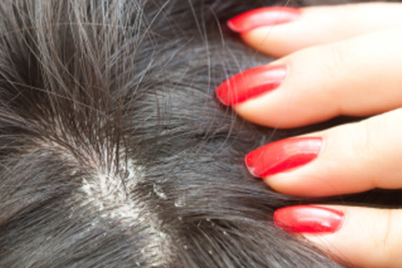 All You Need To Know About Super Lice